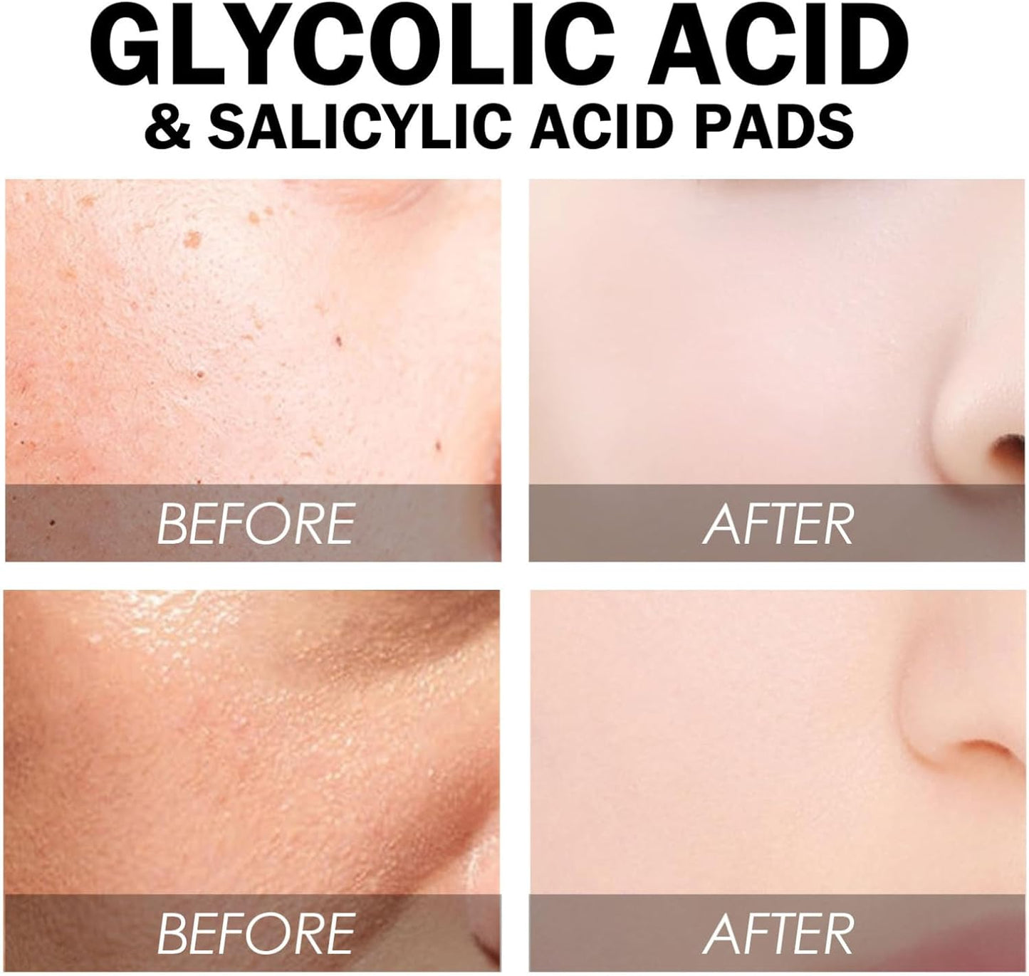 Salicylic & Glycolic Acid Cleansing Pads - Exfoliating Face Pads - Acne Treatment - Reduce Dark Spots, Even Skin Tone (Pack of 55)