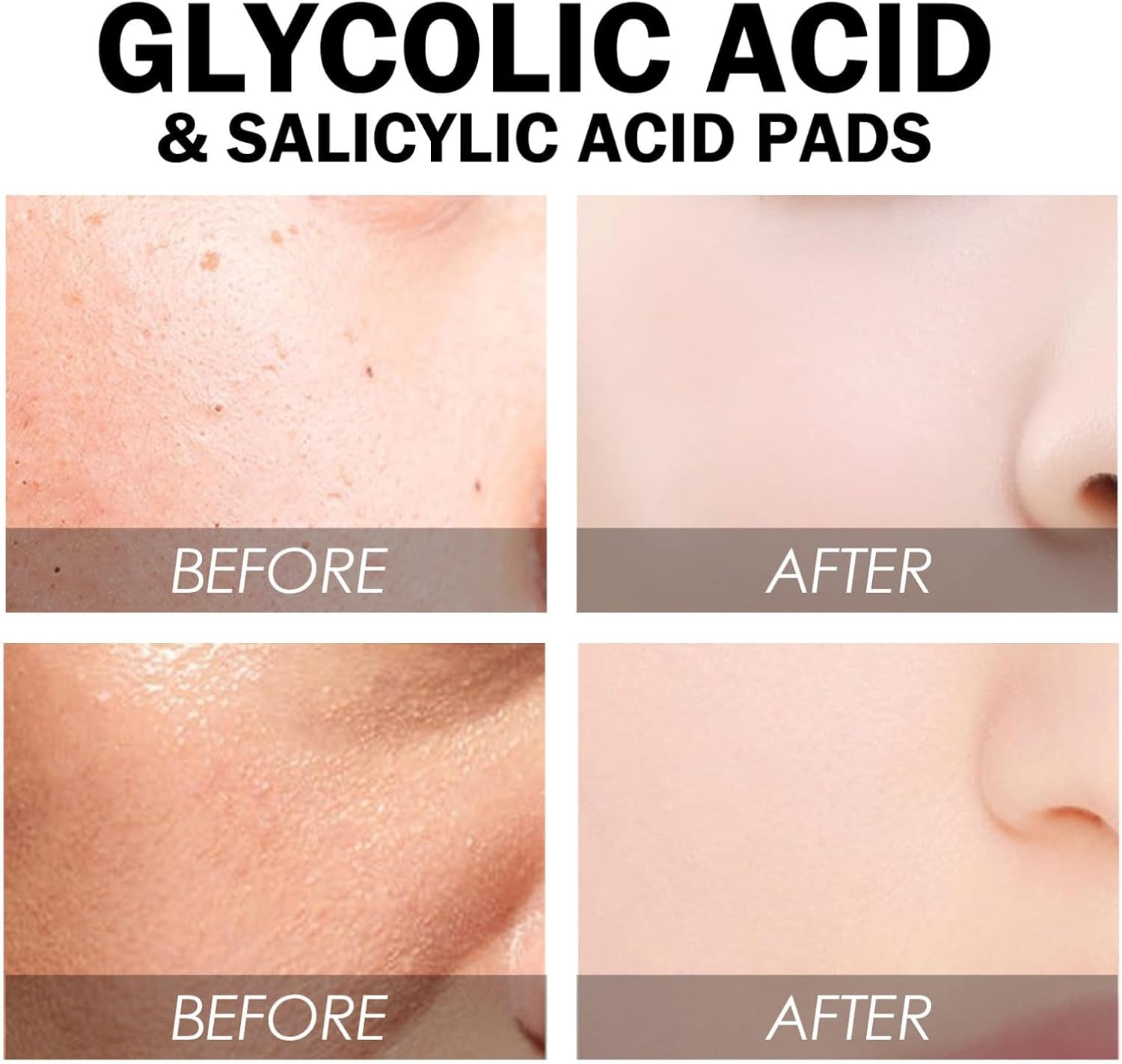 Salicylic & Glycolic Acid Cleansing Pads - Exfoliating Face Pads - Acne Treatment - Reduce Dark Spots, Even Skin Tone (Pack of 55)